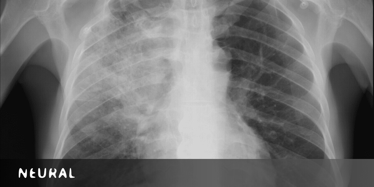 Can Ai Scans Of X Rays Really Detect The Coronavirus