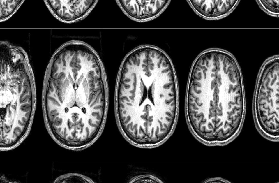 Neuroscientists scanned radicals’ brains to determine what makes them turn violent
