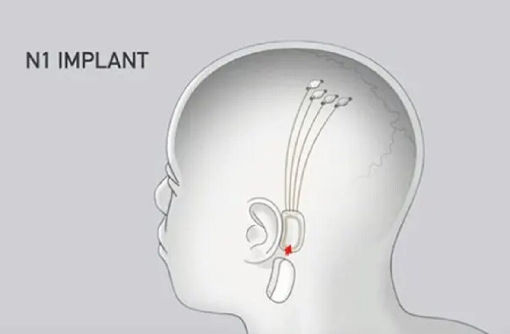 Elon Musk may announce human trials at the Neuralink demo. Here’s why that’s awesome