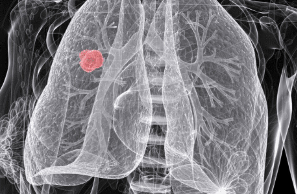 Scientists are using AI to predict which lung cancer patients will relapse