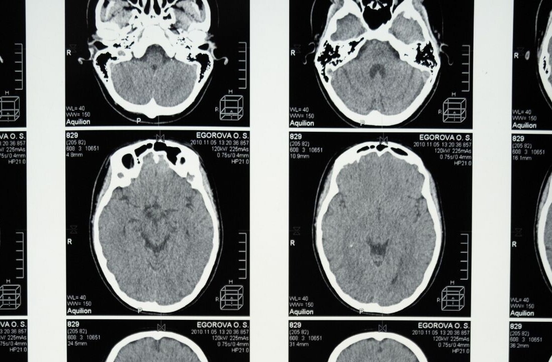 Cambridge scientists say new AI tool could diagnose dementia from a single brain scan