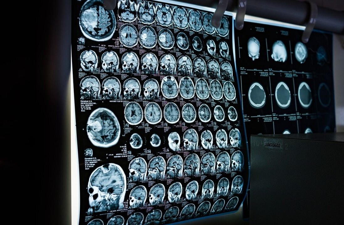 Eye-tracking VR system helps children stay still during MRI scans