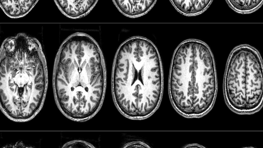 Neuroscientists scanned radicals’ brains to determine what makes them turn violent