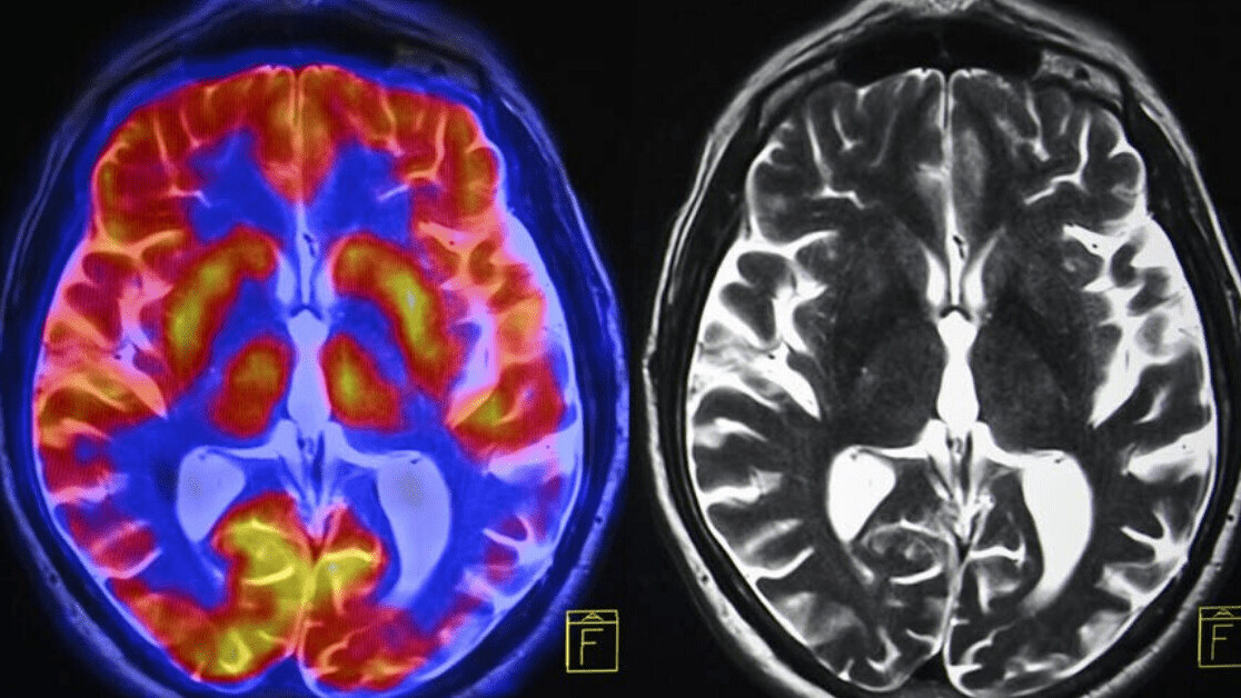 How chronic stress changes the brain — and what you can do to reverse the damage