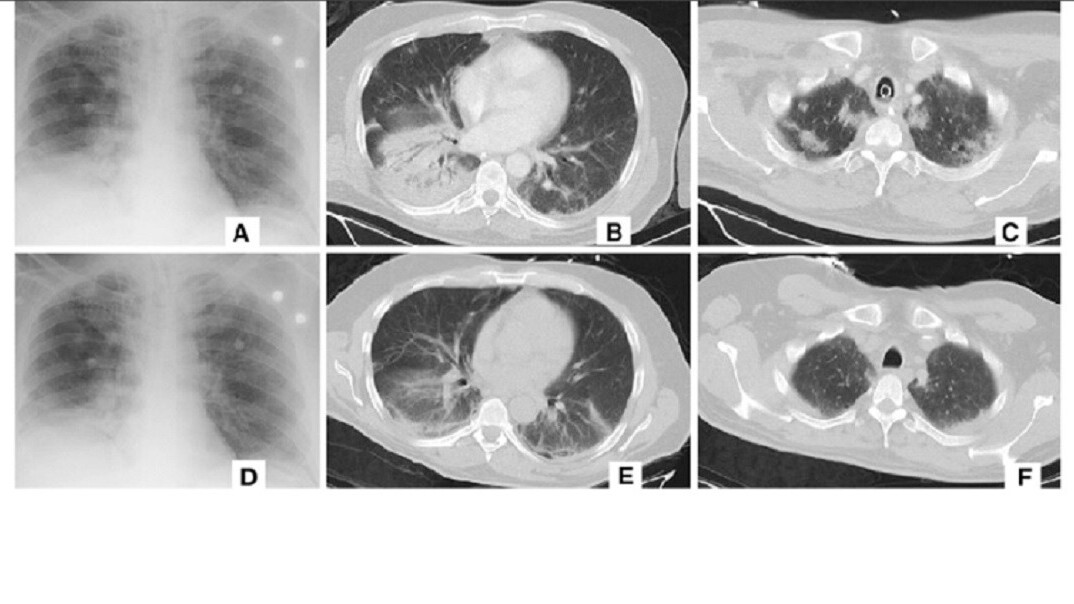 Alibaba’s new AI system can detect coronavirus in seconds with 96% accuracy