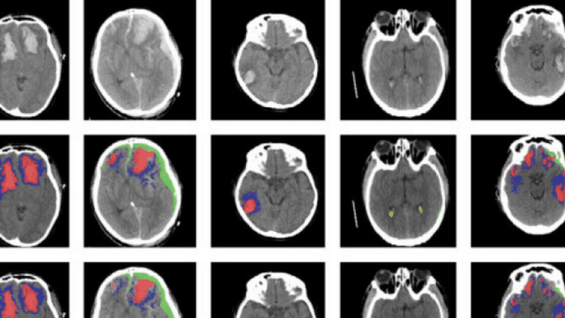 This AI tool automatically identifies different types of brain injury