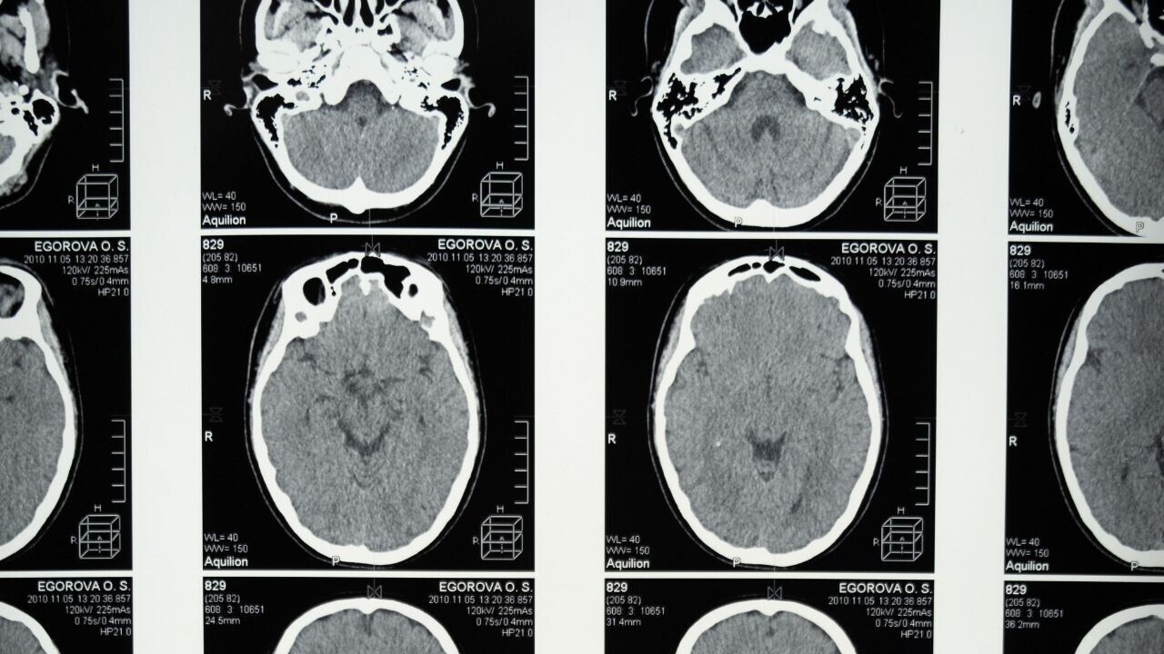 Cambridge scientists say new AI tool could diagnose dementia from a single brain scan