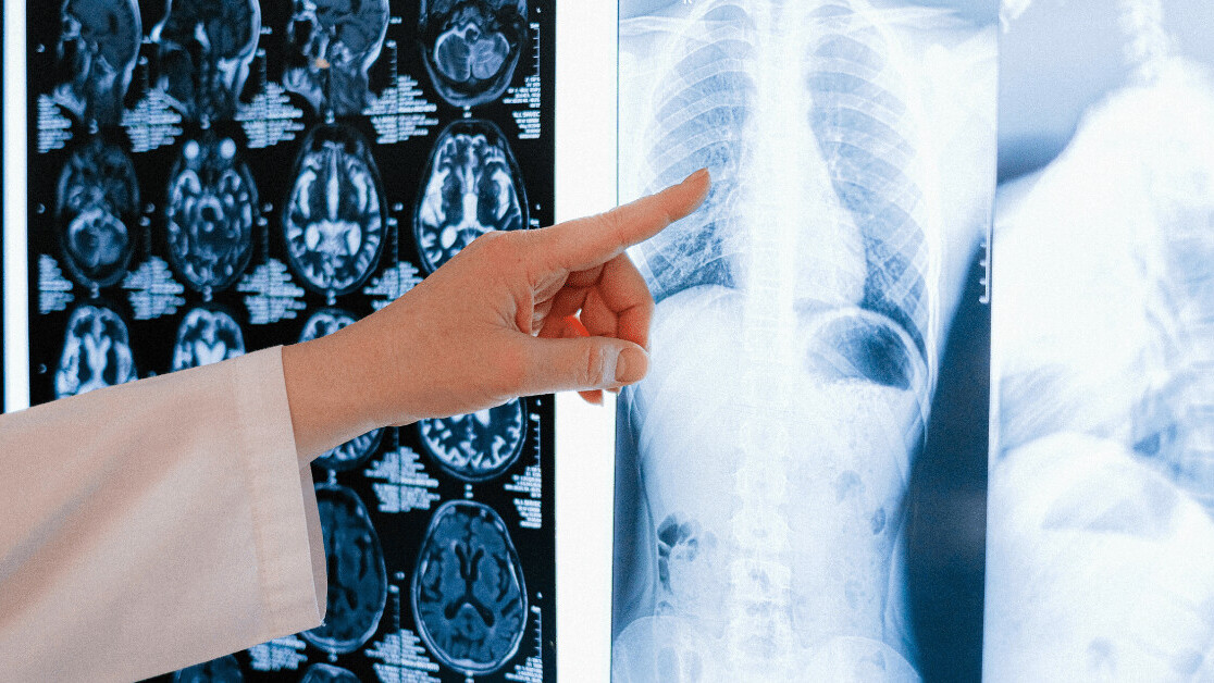AI imaging database for COVID-19 diagnosis provided to UK hospitals