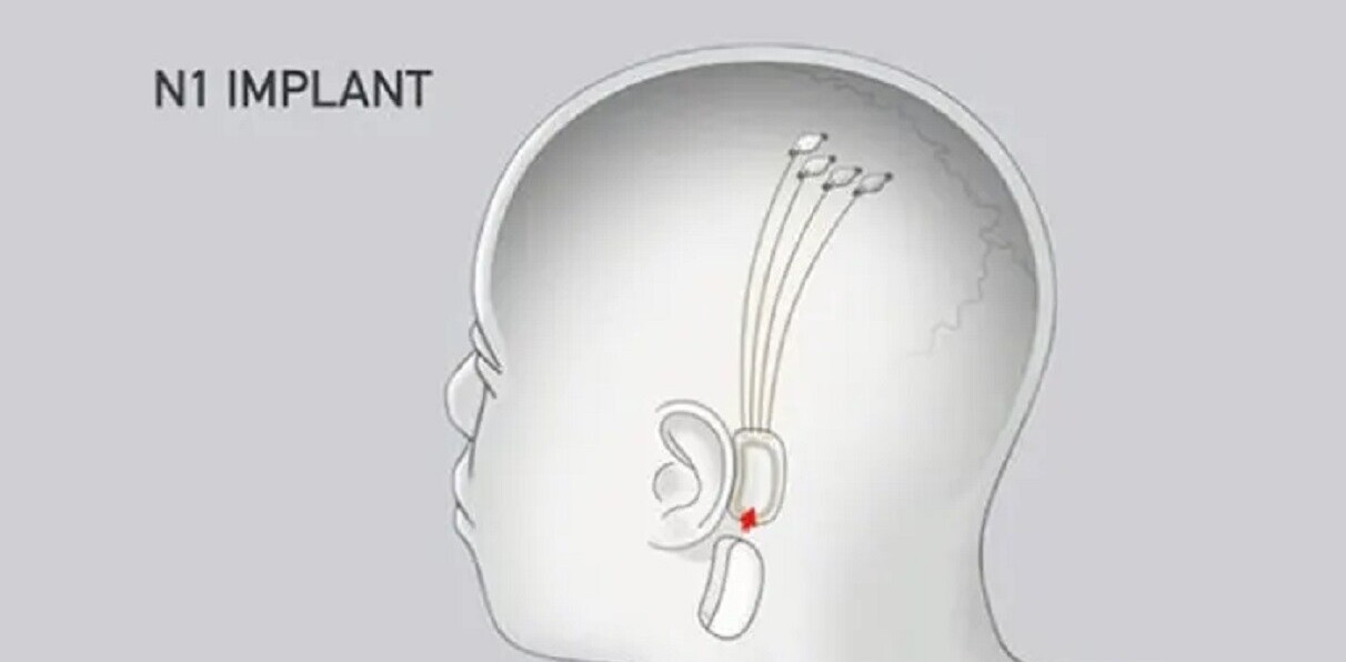 Elon Musk may announce human trials at the Neuralink demo. Here’s why that’s awesome