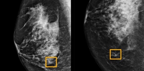 Google’s new AI detects breast cancer just by scanning X-ray