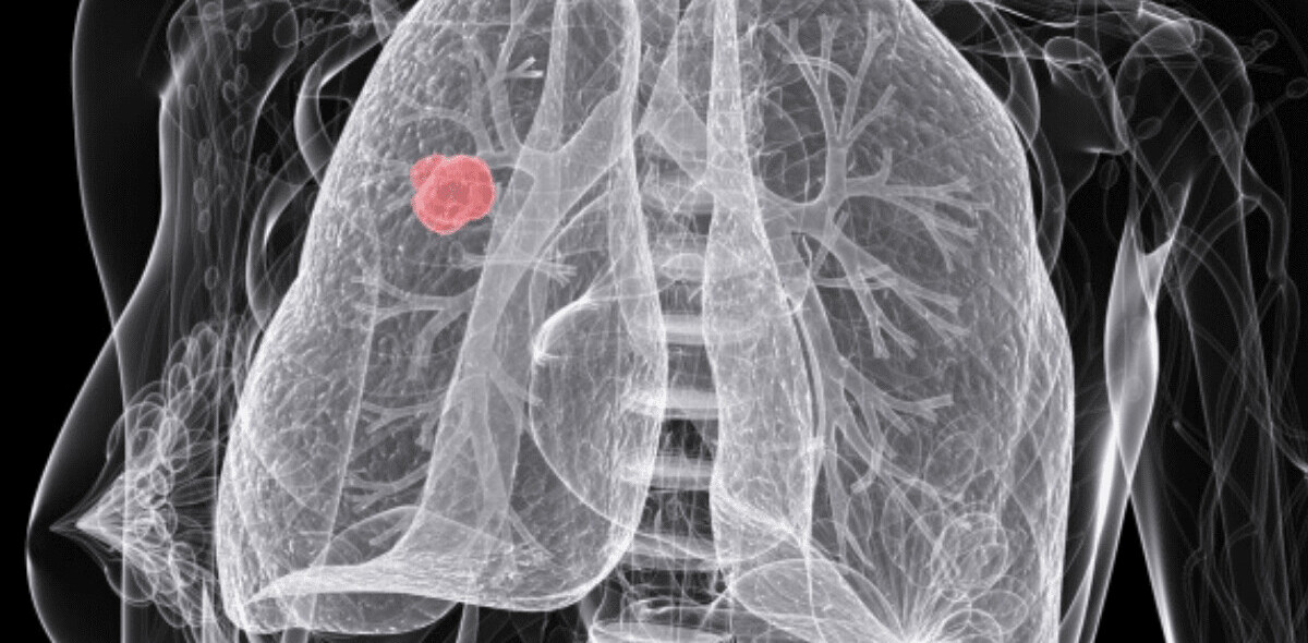 Scientists are using AI to predict which lung cancer patients will relapse