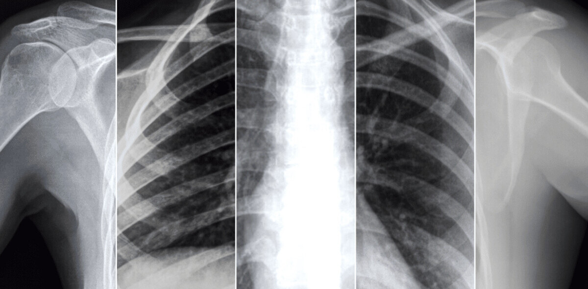 New self-supervised AI models scan X-rays to predict prognosis of COVID-19 patients