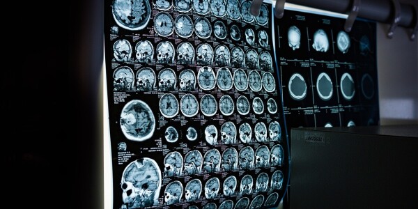 AI nearly twice as good as biopsy at assessing rare cancer