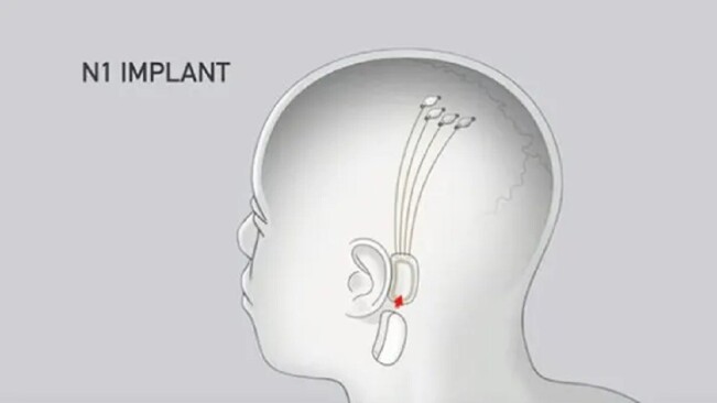 Elon Musk may announce human trials at the Neuralink demo. Here’s why that’s awesome
