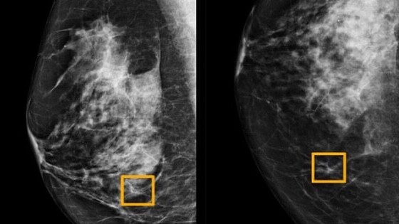 Google’s new AI detects breast cancer just by scanning X-ray