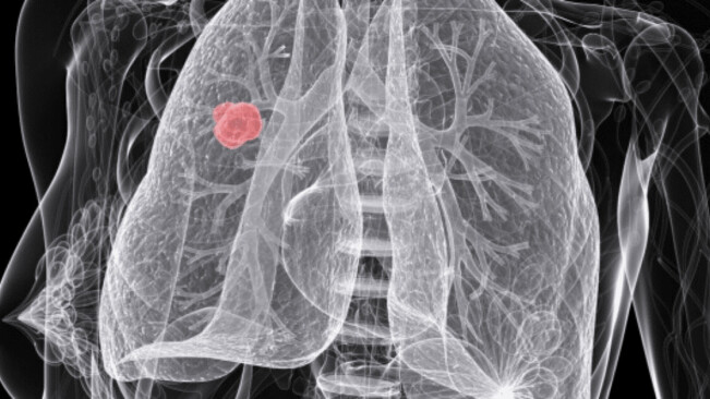 Scientists are using AI to predict which lung cancer patients will relapse